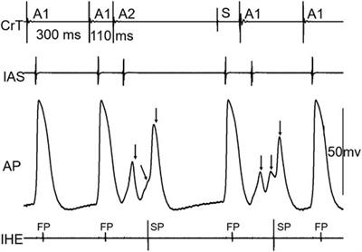 A jump in the atrioventricular conduction curve is not caused by a switch from fast pathway to slow pathway conduction
